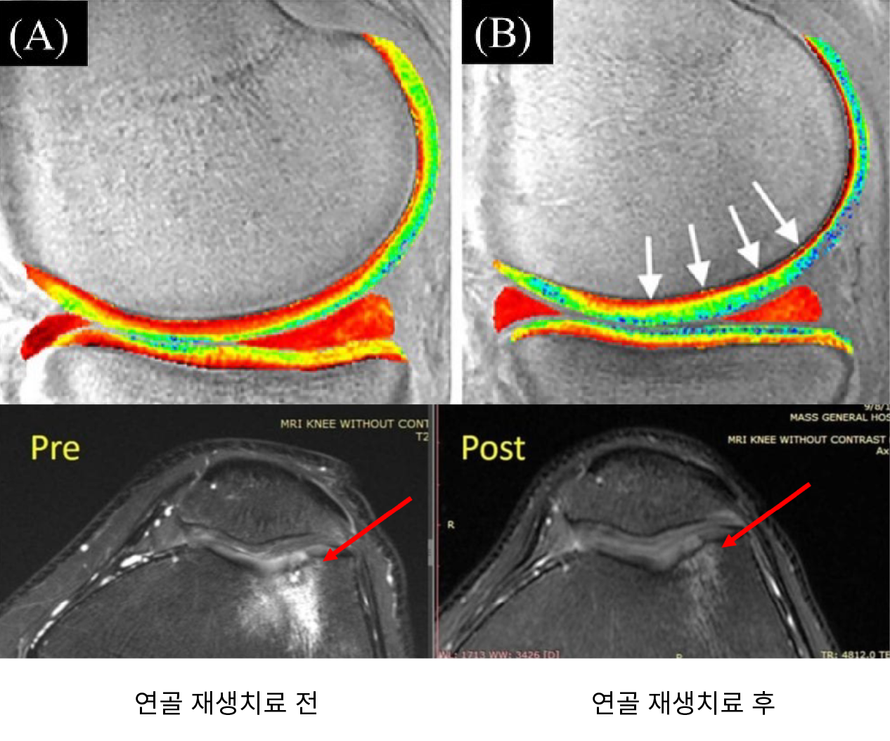 연골 재생치료 전후사진