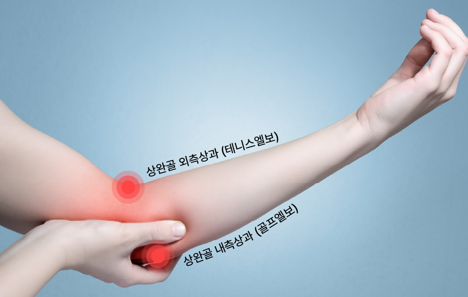 엘보 PRP® 치료란?